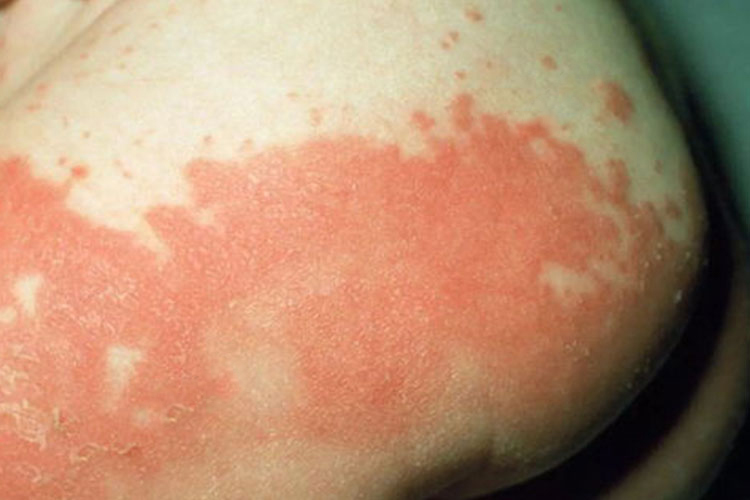 小孩尿不湿过敏臀部红斑图