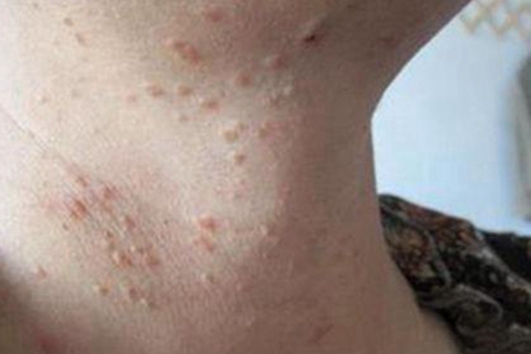 扁平疣颈部症状图 扁平疣颈部症状图