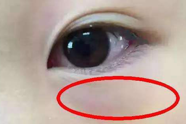 睡眠不足导致下眼皮发紫图