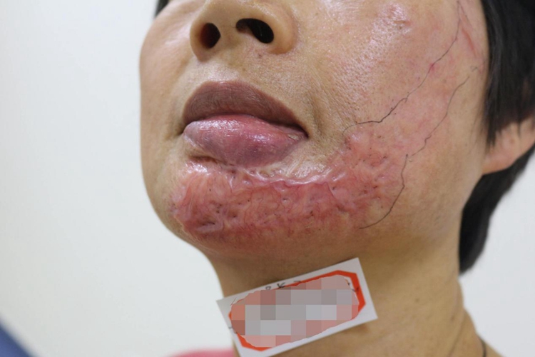 烫伤后瘢痕增生图