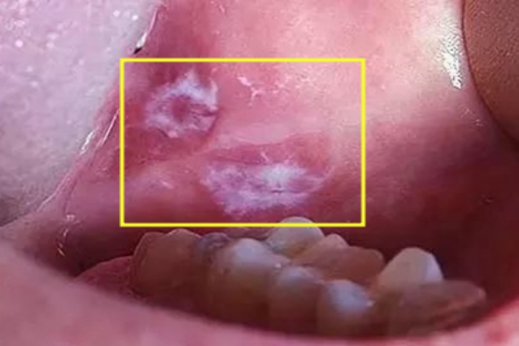 口腔癌口腔溃疡烂了图