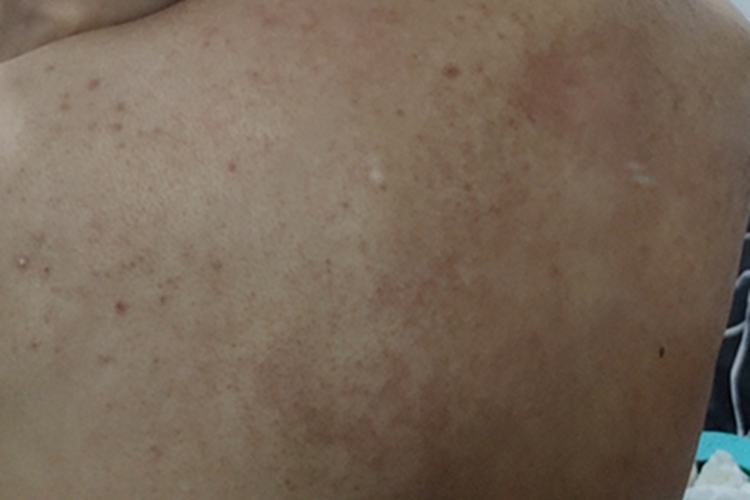 毛囊炎背部很多小丘疹图