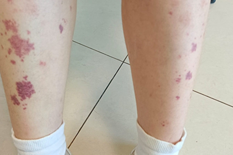 过敏性紫癜小腿紫色斑片图