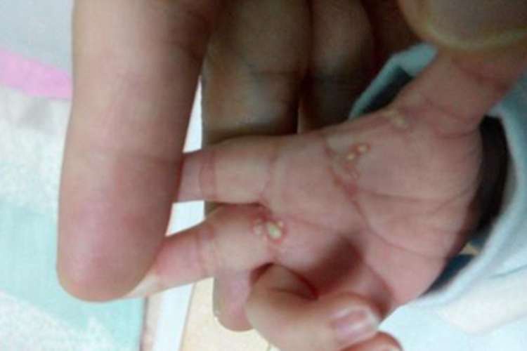 类脂质蛋白沉积症手部症状图 类脂质蛋白沉积症手部症状图