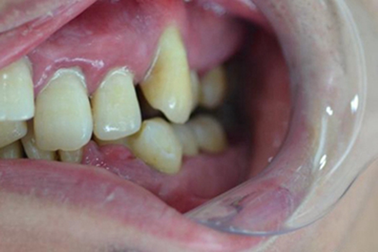 慢性龈炎左上牙龈红肿图