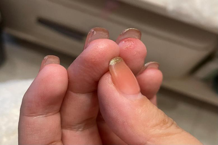 手部指尖湿疹图