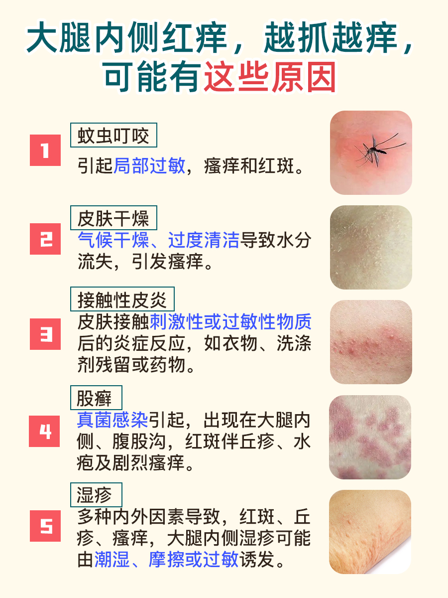 大腿内侧红痒难耐、越抓越痒?你可能忽略了这点