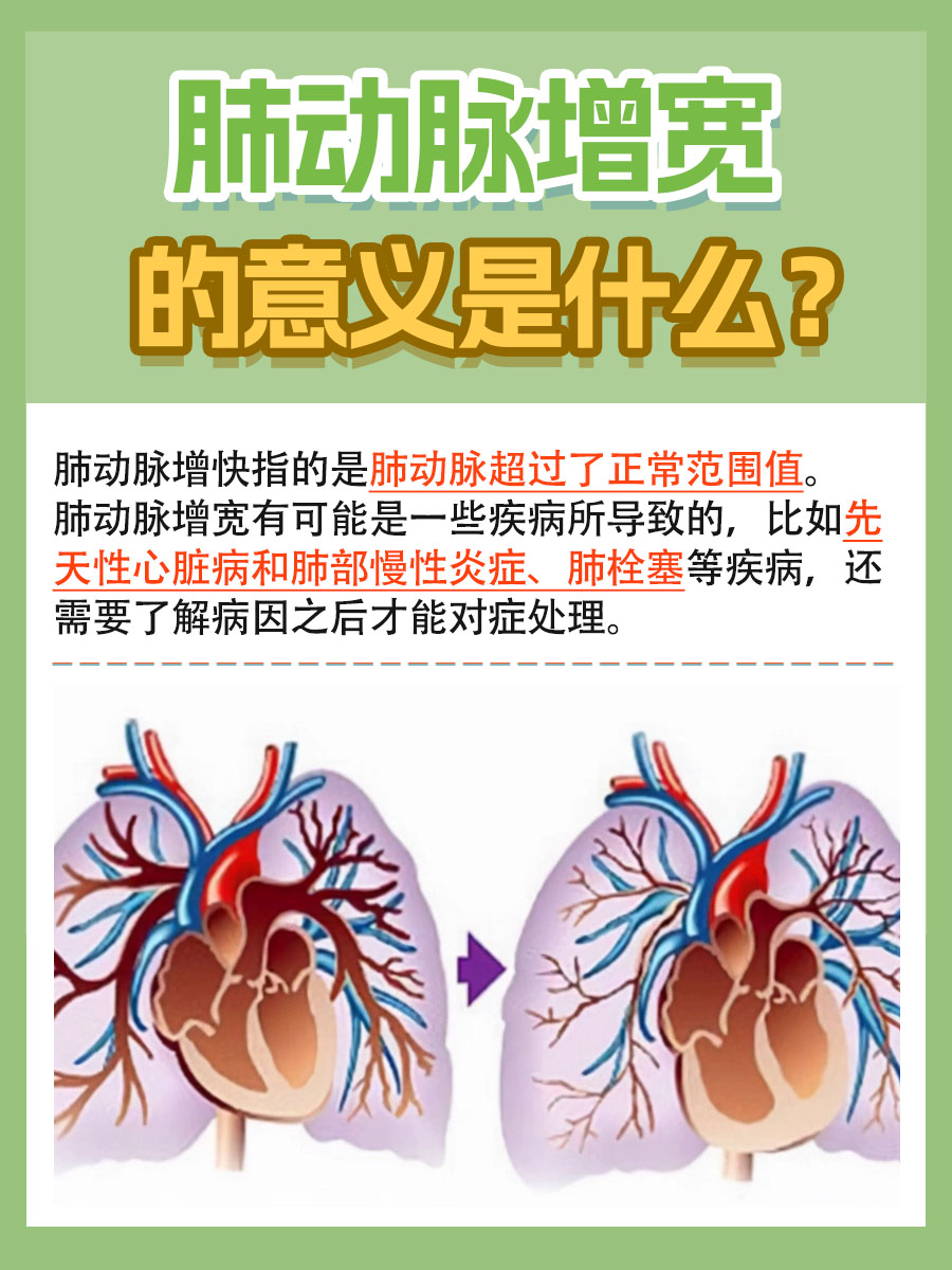 肺动脉增宽，你了解背后真正的意思吗？