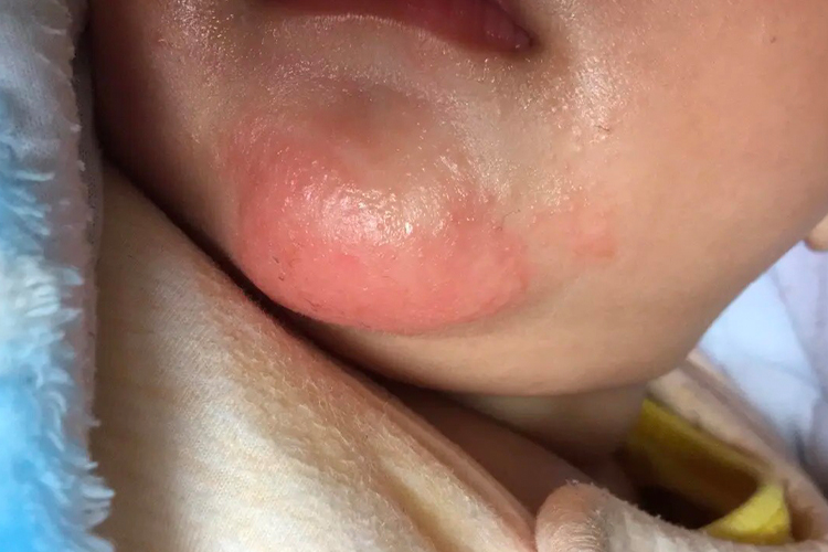 婴儿下巴急性湿疹图