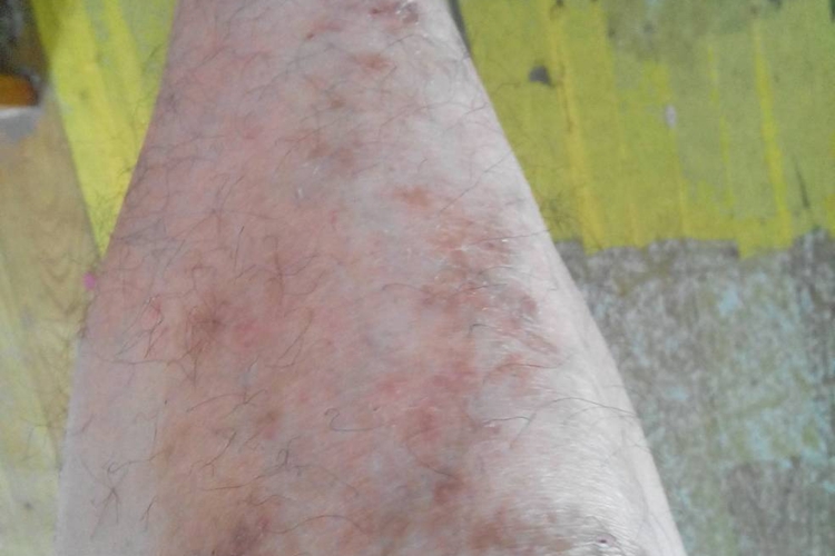 小腿亚急性湿疹症状图