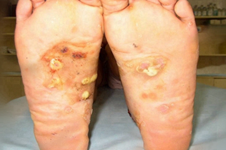 三期梅毒脚底症状图 三期梅毒脚底症状图