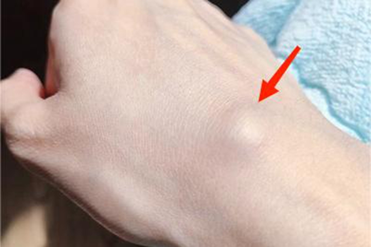 腱鞘纤维瘤手背症状图