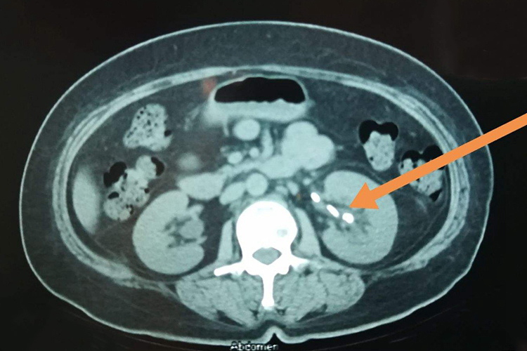 输尿管结石CT图