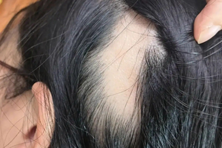 油风脱发头发大片脱落图