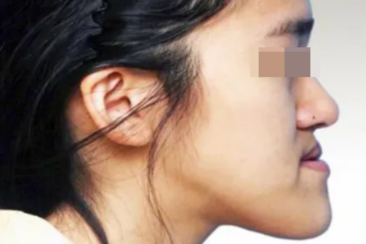 下颌发育畸形严重前突图 下颌发育畸形严重前突图