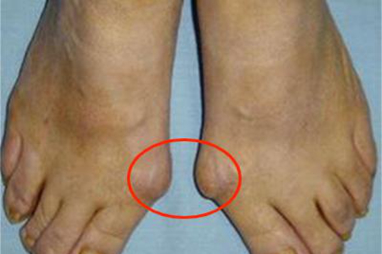 拇趾滑囊炎脚趾肿块图 拇趾滑囊炎脚趾肿块图