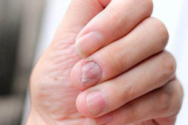 甲纵裂手指甲缺损开裂图