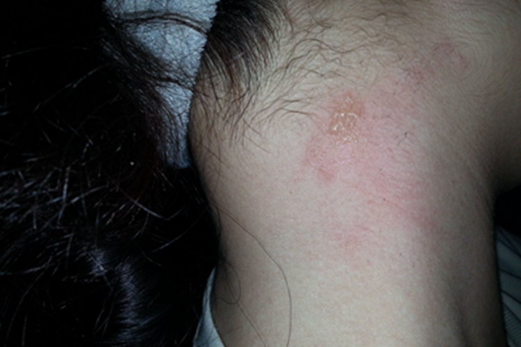 蝎蜇伤侧颈症状图