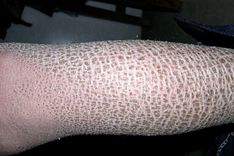 获得性鱼鳞病小腿症状图