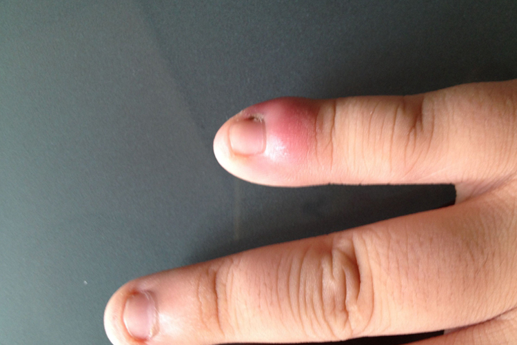 手指局部肿图 手指局部肿图