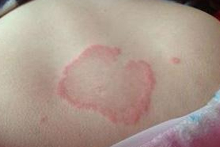 慢性迁移性红斑图