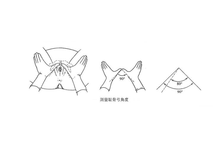 耻骨弓角测量图