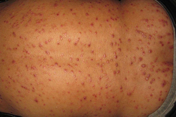 成人痒疹小疙瘩图 成人痒疹小疙瘩图