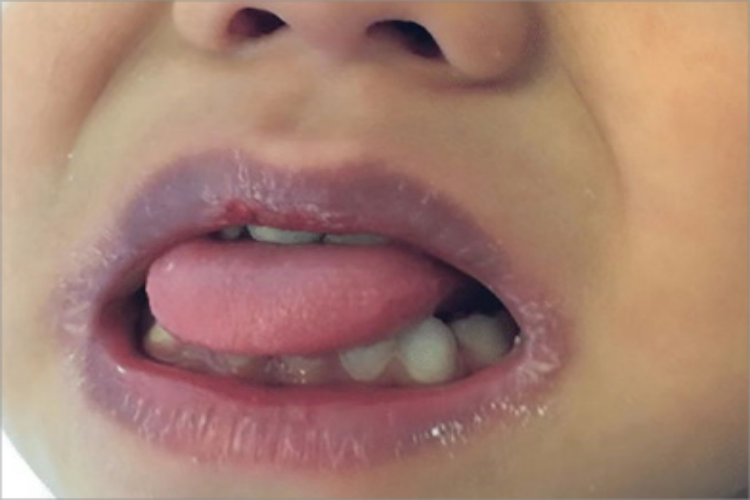 川崎病嘴唇干燥图