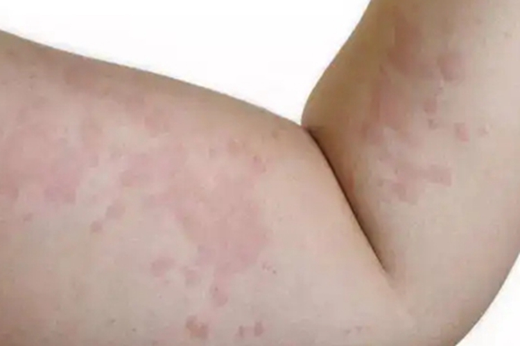 青霉素过敏胳膊症状图