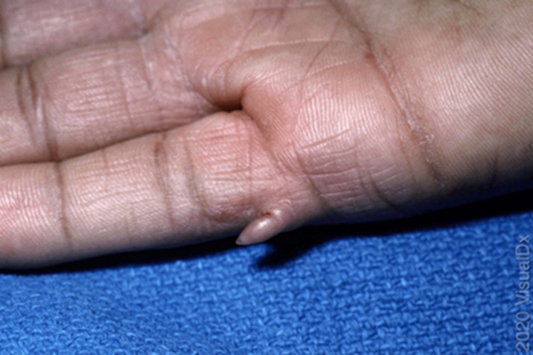 单发性有蒂软纤维瘤疙瘩图