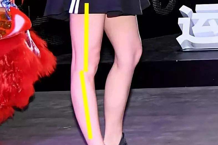 膝关节超伸外观图 膝关节超伸外观图