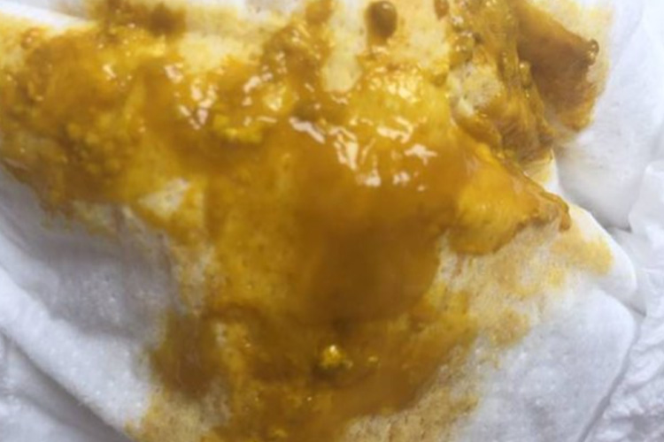 黏液脓性便图