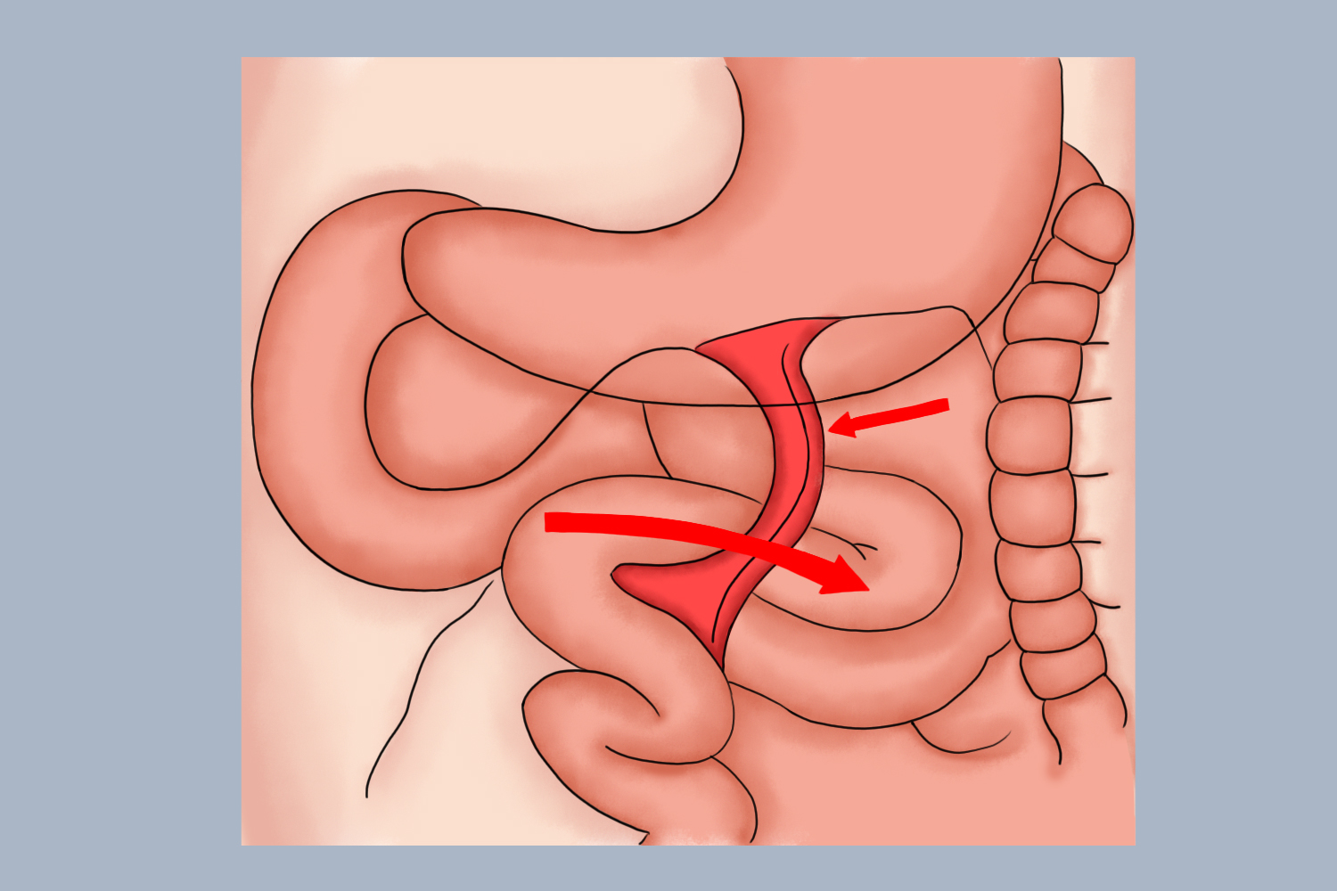 左侧十二指肠旁疝示意图