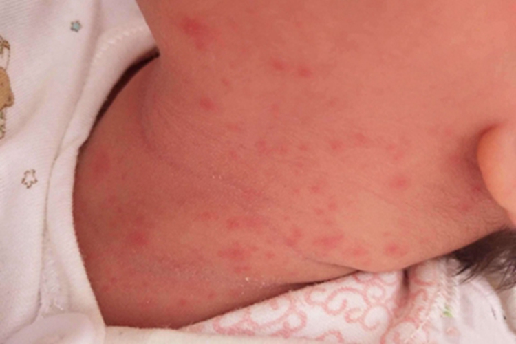 红痱侧颈长了很多红点图 红痱侧颈长了很多红点图