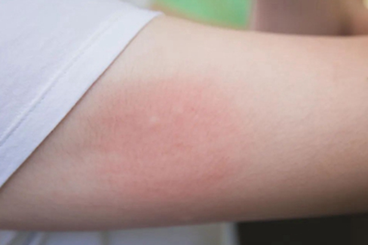 蚊虫叮咬胳膊红疙瘩图
