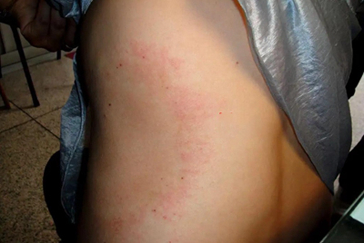 离心性环形红斑侧腰上起大红圈图