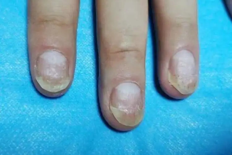 念珠菌性甲真菌病图 念珠菌性甲真菌病图