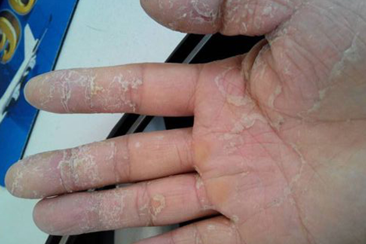掌跖角化病图