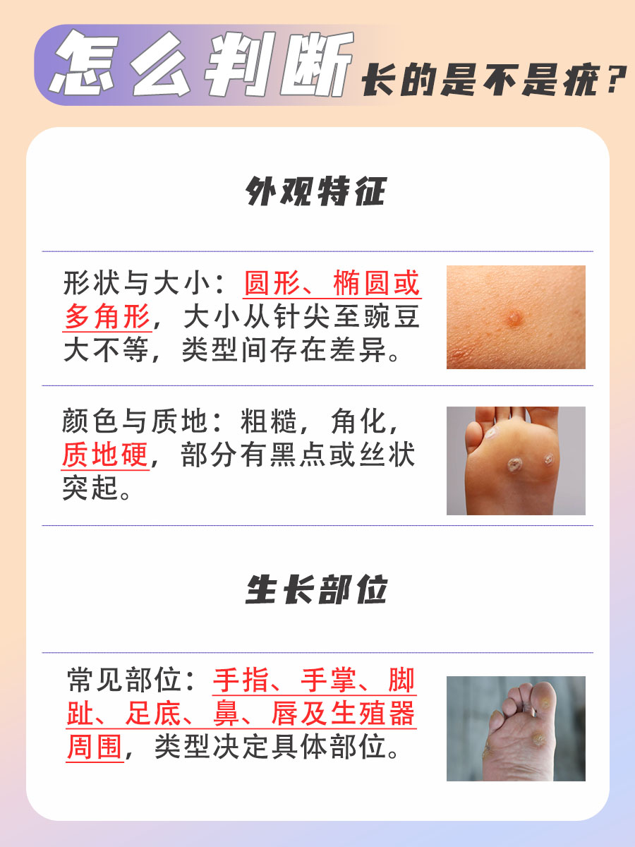 从形状到颜色，全面解析如何判断疣的真面目！