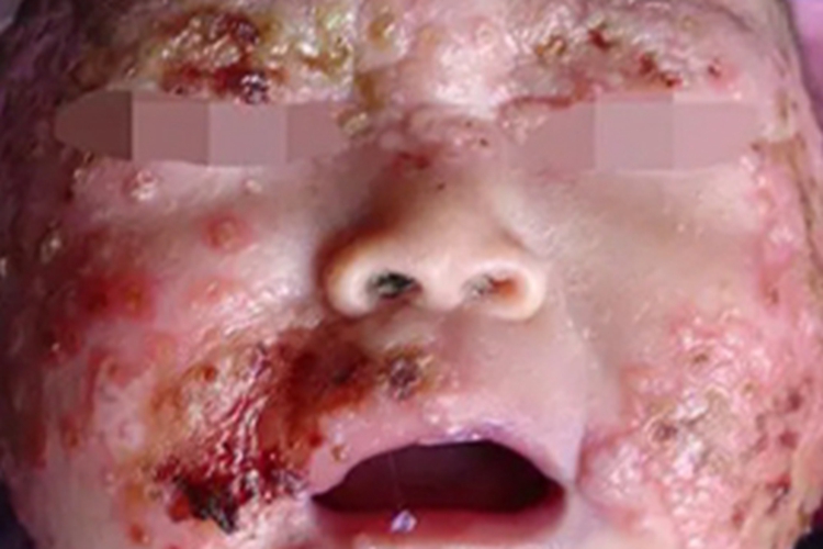 感染性湿疹水疱图