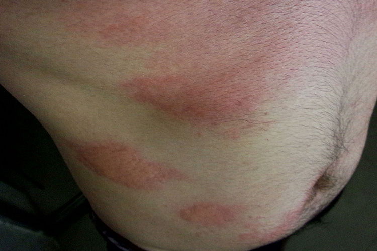 躯干风疹图 躯干风疹图