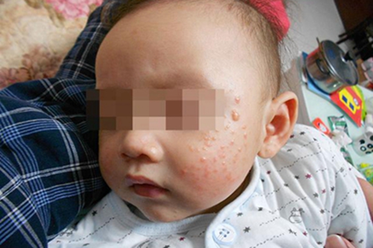 婴儿期特应性皮炎面部水疱图 婴儿期特应性皮炎面部水疱图