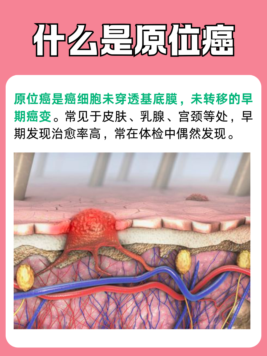 原位癌是什么，早期癌症知识普及