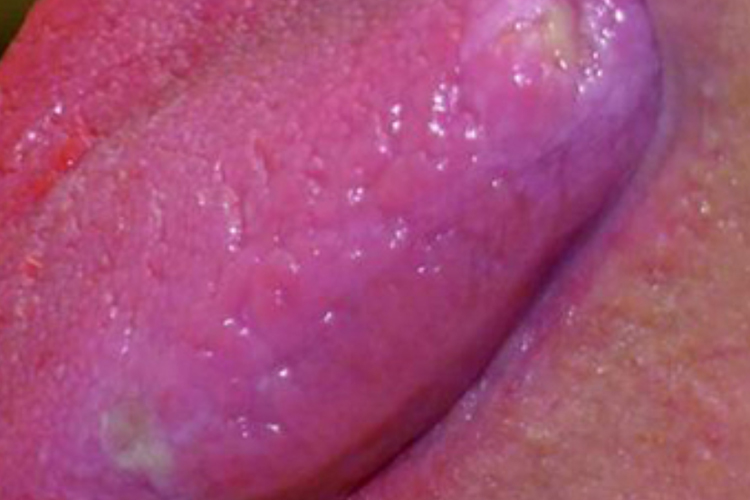 白塞病引起舌头烂了图 白塞病引起舌头烂了图