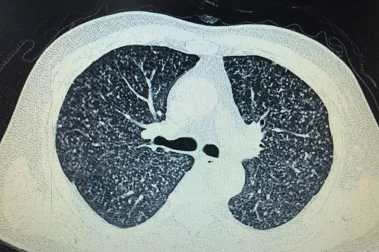 肺结核CT表现图