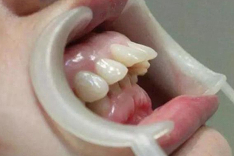 龅牙症状图 龅牙症状图