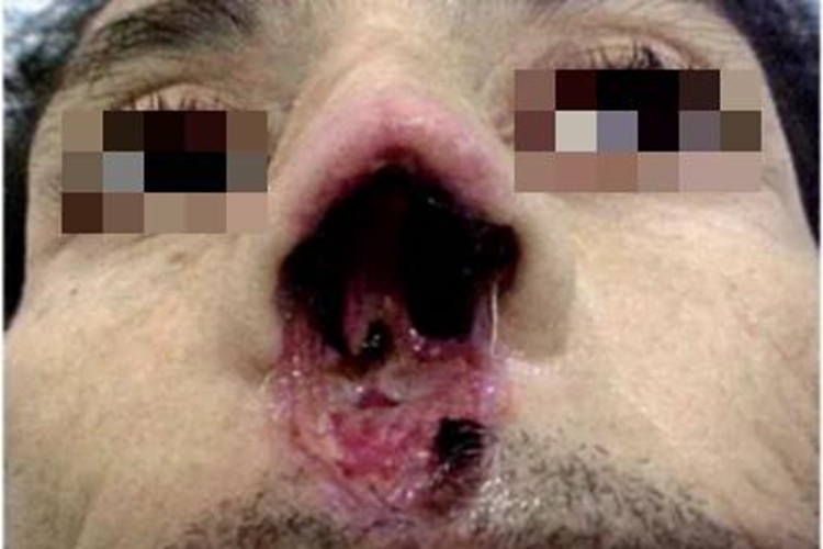 皮肤利什曼病缺损图 皮肤利什曼病缺损图