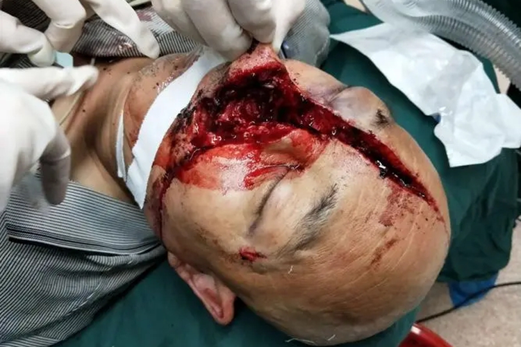 开放性颅脑损伤前额症状图 开放性颅脑损伤前额症状图