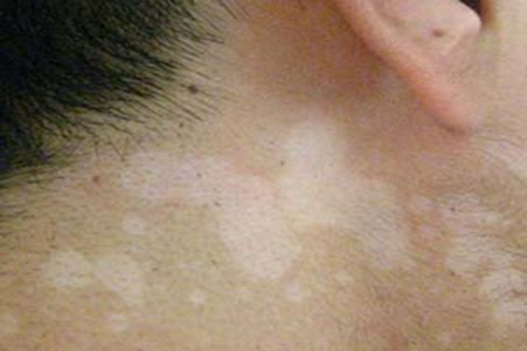 花斑糠疹颈部白斑图