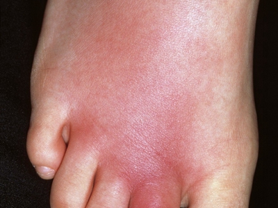 嗜酸性蜂窝织炎的症状和图片 - 有来医生